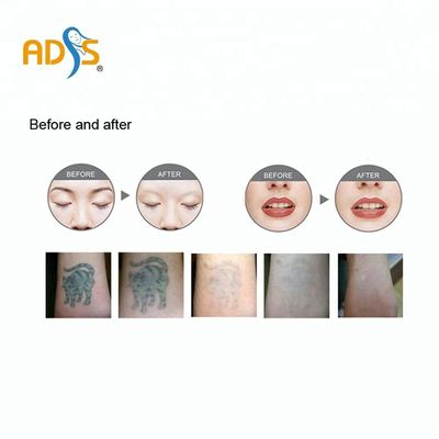 Q Switched Nd Yag Laser Pico Laserowa maszyna do usuwania tatuaży 1064nm 532nm