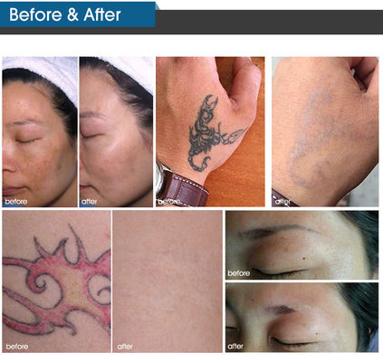 Pionowa maszyna laserowa Picosecond Laser do usuwania pigmentacji
